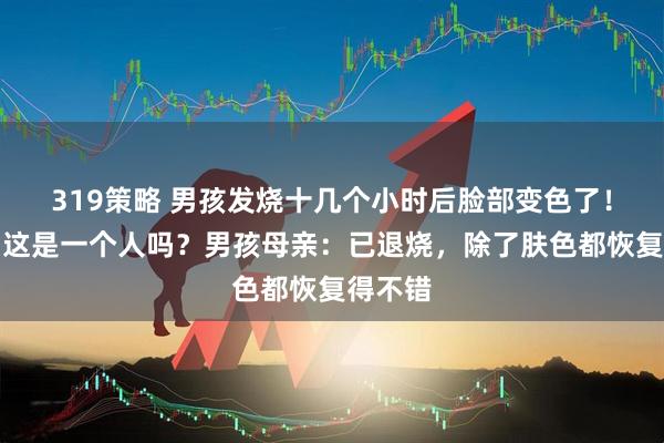 319策略 男孩发烧十几个小时后脸部变色了!网友:这是一个人吗?男孩母亲:已退烧,除了肤色都恢复得不错